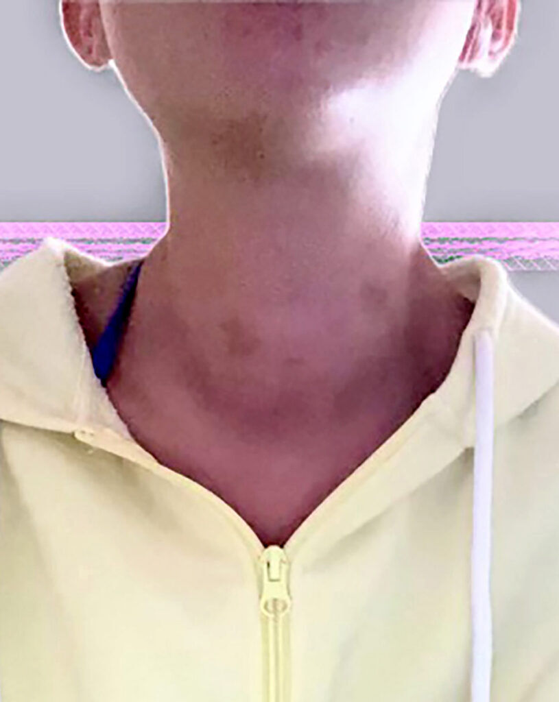 Bruises can be seen on Kiersten May’s neck after she said she was raped on May 26, 2024, on her high school graduation campout outside Steamboat Springs, Colo. (Photo courtesy of the May family)